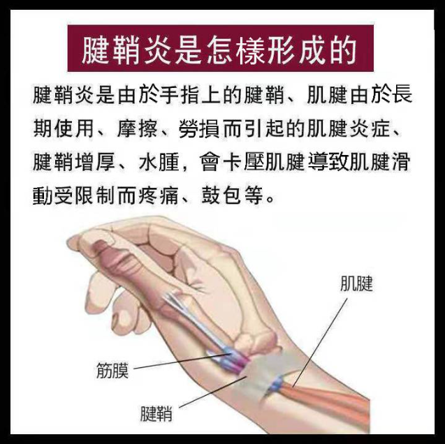 腱鞘炎 囊腫 關節無力 大拇指疼痛 專用手指關節疼痛貼